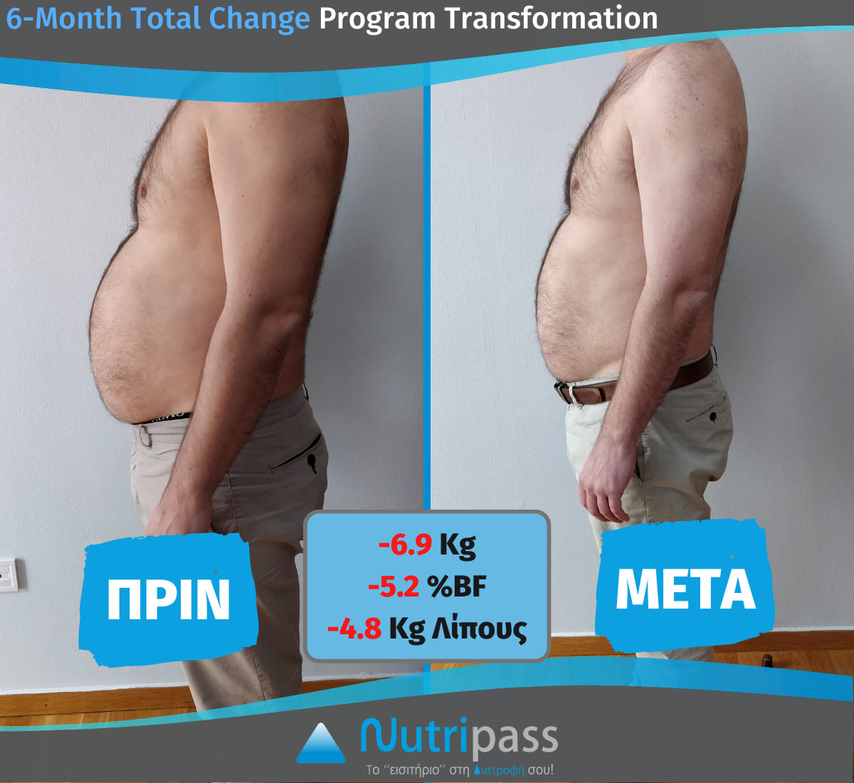 NEW_Karvounis Before After Left Side 6 months