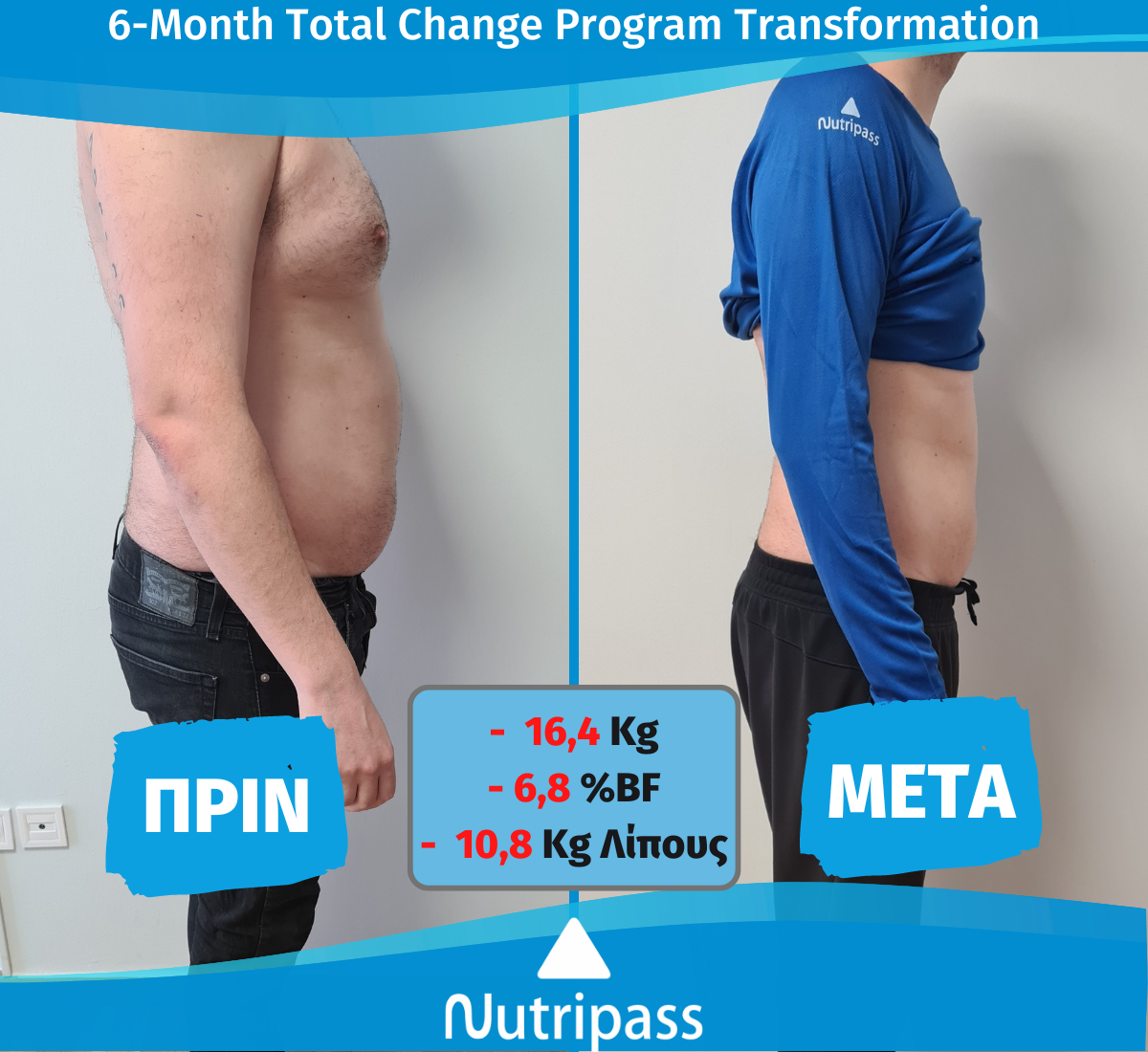 Vakalopoulos Before After Right Side 6 Months New